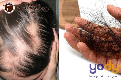 Các nguyên nhân gây rụng tóc ở nam giới  Vinmec